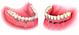 Prothèse Fixe complète sur implants