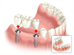 Bridge sur implant